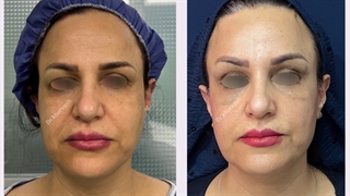 یک ماه پس از لیفت آندوسکوپی ابروها و پیشانی