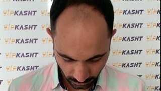 نتیجه یک سال بعد از کاشت مو به روش جدید-کلینیک vip تهران