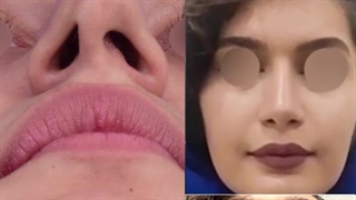 جراحی زیبایی بینی کج با سوراخ های نامتقارن