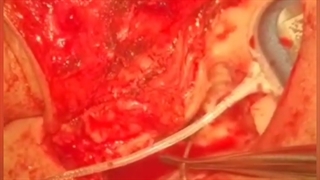 عمل جراحی کاشت حلزون چگونه انجام می شود؟