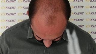 نتیجه طاسی وسیع با کاشت کل سر - هرروز یک شگفتی کلینیک vip تهران