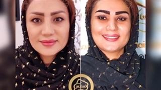 کاشت ابرو
