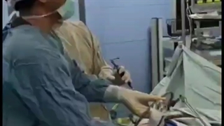 احتمال ایجاد سنگ کیسه صفرا پس از جراحی چاقی