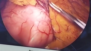 آیا کوچک کردن و تنگ کردن معده باقی مانده در جراحی اسلیو باعث لاغری بیشتر میشود؟