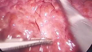 کبد چرب و چاقی