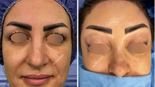 لیفت آندوسکوپی ابروها و پیشانی