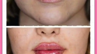 تزریق ژل لب طبیعی و نچرال