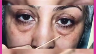جراحی پلک پایین