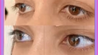 لیفت ابرو با مواد چیست؟