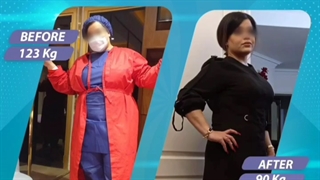 قبل و بعد جراحی اسلیو معده توسط بهترین دکتر تهران