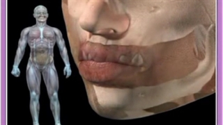 جراحی دهان بزرگ