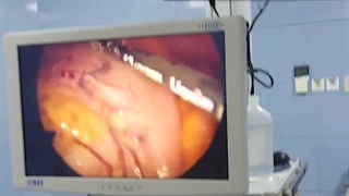 اسلیو معده به علت چاقی مجدد بعداز پلیسه معده