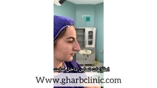 جراحی بینی استخوانی