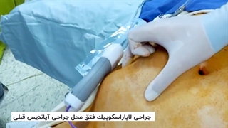 جراحی لاپاراسکوپیک فتق محل جراحی آپاندیس