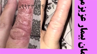 درمان اگزما