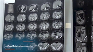 جراحی چسبندگی داخل شکم و انسداد روده