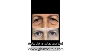رفع افتادگی پلک