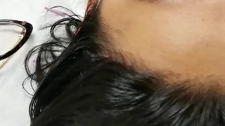 جوانسازی صورت با طب سوزنی تزریق بوتاکس