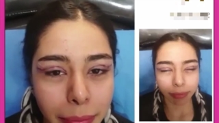 همه چیز درباره عمل زیبایی چشم