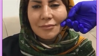 مهترین مراقبت های بعد از لیفت با نخ چیست؟