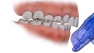 دستگاه فانکشنال ارتودنسی.متخصص ارتودنسی دکترعلیرضاخدیوی