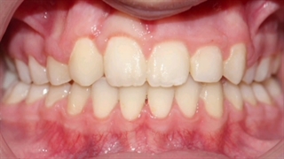 نمونه درمان ارتودنسی دکترعلیرضاخدیوی متخصص ارتودنسی