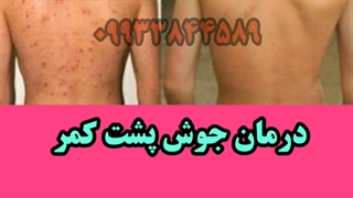 درمان جوش جوانسازی پوست