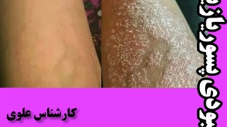 بهبودی پسوریازیس