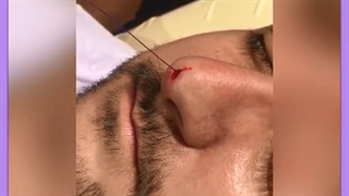 لیفت بینی استخوانی امکان پذیر است؟