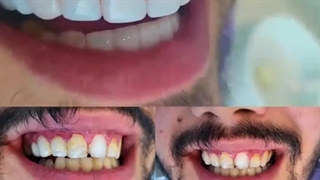 نمونه کار زیبایی کامپوزیت | دکتر سعید میرزایی