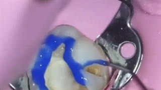 ترمیم پوسیدگی دندان