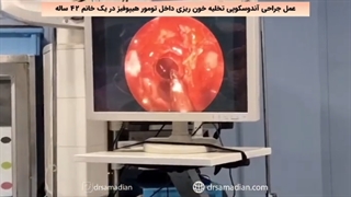 جراحی آندوسکوپی تخلیه خونریزی داخل تومور هیپوفیز