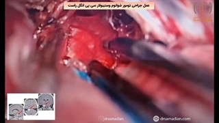 عمل جراحی تومور شوانوم وستیبولار سی پی انگل راست