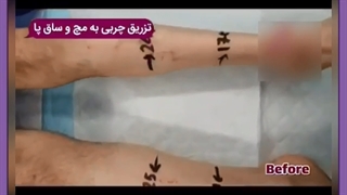 فیلم تزریق ژل به ساق پا