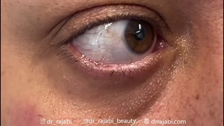 جراحی برداشتن تمام صخامت تومور پلک پایین و بازسازی لایه به لایه پلک