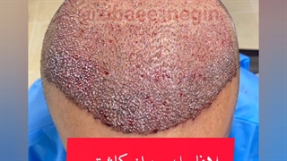 کاشت موی یک روزه، بعد از 20 روز، گرگان 09336093000 گنبد کردکوی بهشهر بندرگز گلوگاه