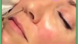 تزریق چربی به صورت لب و گونه ماندگاری عوارض و مزایا