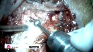 چگونگی عمل جراحی کلستئاتوم