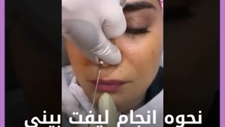 بهترین کاندید ها برای لیفت بینی چه افرادی هستند؟ بررسی لک صورت