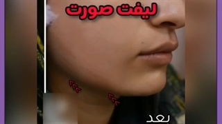 انتخاب بین جراحی و لیفت با نخ؟