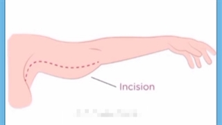 توصیه ها و مراقبت های لیفت بازو