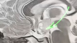جراحی کودک ۸ ساله مبتلا به نوروفیبروماتوز نوع یک
