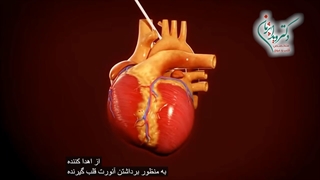 پیوند قلب ارتوتوپی