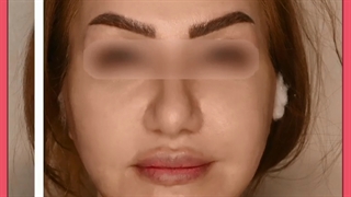 مهمترین مزایای لیفت صورت با نخ