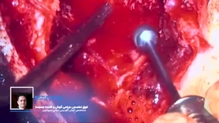 چگونگی جراحی قاعده جمجمه لترال