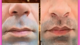 لیفت لب شاخ گاوی