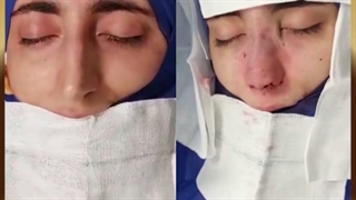 جراحی بینی با قوز و افتادگی بسیار شدید نوک بینی