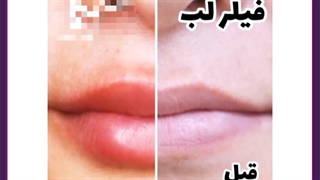 بهترین دکتر برای تزریق فیلر در تهران تزریق ژل