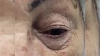 بلفاروپلاستی پلک