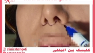 لیفت لب با جراحی